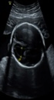 Analysis of Antenatal Sonographic Features of the Fetuses with Trisomy 21