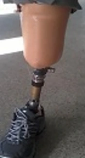 The Effects of Ankle Turner Unit on the Quality of Life of Unilateral Below Knee Amputees