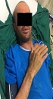 Severe TEN Management in a Patient with Schizophrenia