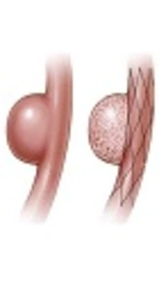 Mid-Term Outcome Following Pipeline Embolization of Unruptured Intracranial Aneurysms
