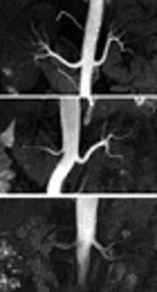 Relationship Between Blood Flow Velocity and Blood Suppression Inversion Time for Optimal Visualization of Renal Artery in Spatial Labeling with Multiple Inversion Pulses: In Vitro Study