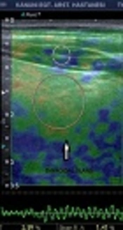 Value of Real-Time and Strain Ratio Elastography in Differential Diagnosis of Graves’ Disease and Subacute and Hashimoto’s Thyroiditis