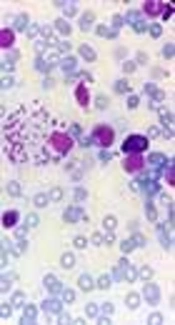 Visceral Leishmaniosis in Bone Marrow Aspiration
