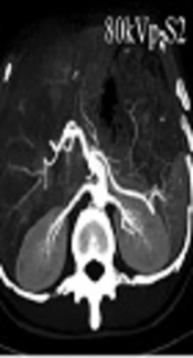 Optimization of Scan and Reconstruction Parameters for Renal Artery CT Angiography with Iterative Reconstruction at Low kVp Compared with Filtered Back Projection at 120 kVp Acquisition