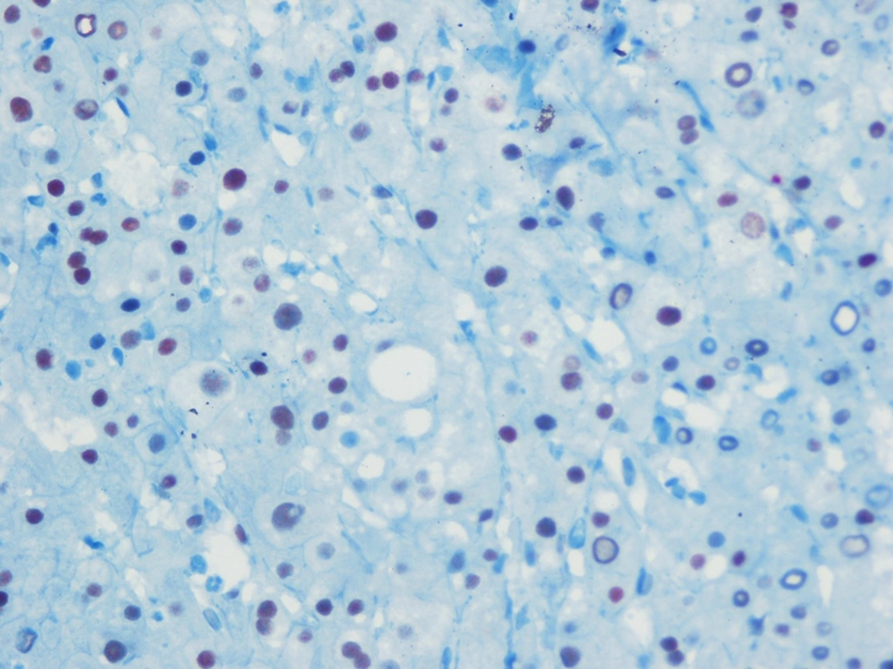 Low Expression of Estrogen Receptor α in the Livers of Patients Infected With Hepatitis C Virus Genotype 1b. Low Expression of Estrogen Receptor α in the Livers of Patients Infected With Hepatitis C Virus Genotype 1b.
