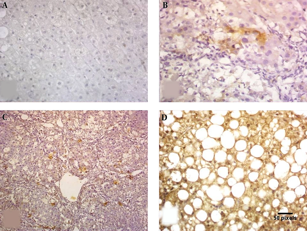 Caspase 3 IHC: A, negative staining; B, mild cytoplasmic staining; C, moderate cytoplasmic staining; D, marked cytoplasmic staining (× 400). Caspase 3 IHC: A, negative staining; B, mild cytoplasmic staining; C, moderate cytoplasmic staining; D, marked cytoplasmic staining (× 400).
