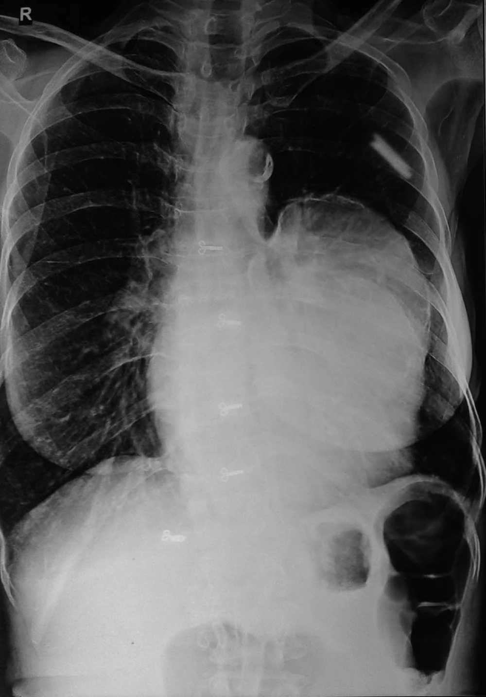 Chest X-Ray Showing Bulging of Left Heart Border Chest X-Ray Showing Bulging of Left Heart Border