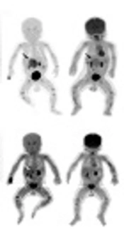 Clinical Characteristics of Peripheral Neuroblastic Tumors in Children: A Single-Center Experience of 43 Cases