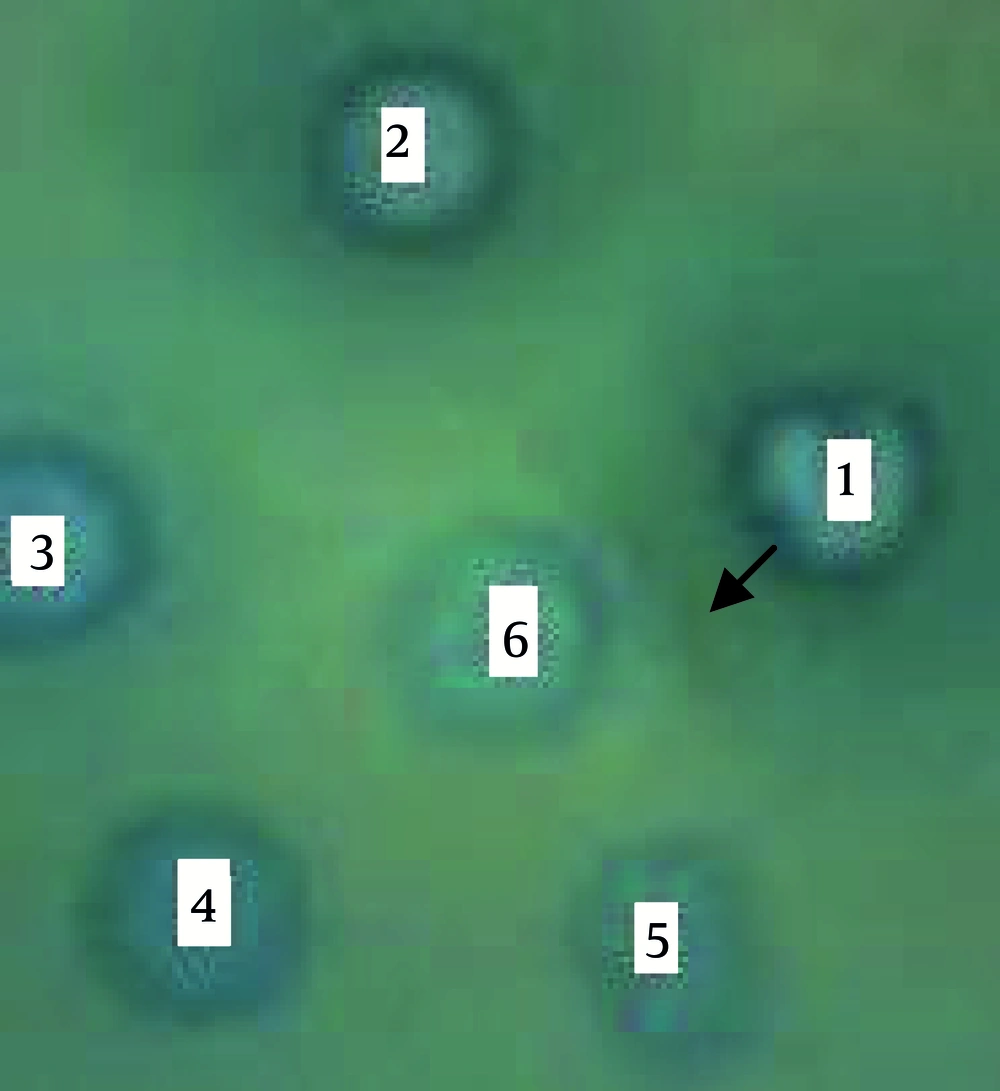 Analyses of Recombinant p4 Protein by Double Diffusion Using Cutaneous Leishmaniasis Mouse Serum as an Antibody (S) and Bacteria Lysate as an Antigen (1, 2, 3), Prior to Induction, 5 h and Overnight After Induction 1: Bacteria lysate with the recombinant plasmid (rpQE-30), 5 h after induction, 2: Bacteria lysate with the recombinant plasmid (rpQE-30), overnight after induction, 3: Bacteria lysate with the recombinant plasmid (pQE-30-4), prior to induction, 4: Bacteria lysate alone 5: Bacteria lysate with the intact plasmid (pQE-30)