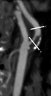 Assessment of the Correlation Between Carotid Artery Plaque Density Determined by Histogram Analysis and Positive Remodeling on Computerized Tomography Angiography