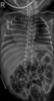 A Case of Early Diagnosis of Pyruvate Dehydrogenase Complex Deficiency: The Use of Next-Generation Sequencing