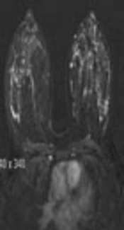 Is Background Parenchymal Enhancement in Breast Magnetic Resonance Imaging Associated with Breast Cancer?