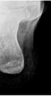Bilateral Calcification of Achilles’ Tendons, and Acetic Acid Iontophoresis Plus Ultrasound Effectivenness