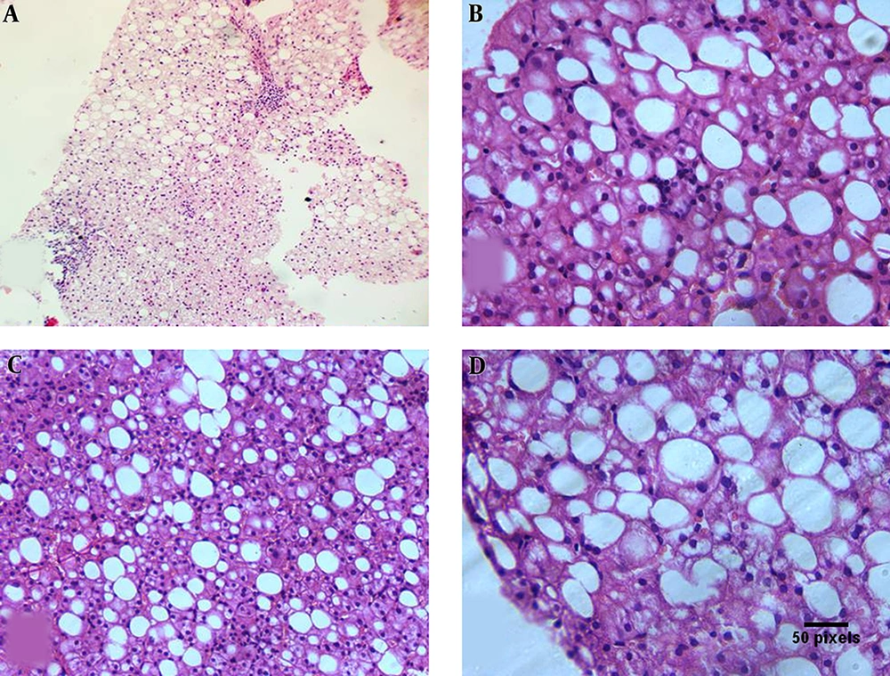 A, Liver biopsy showing mild macrovesicular steatosis and mild portal inflammation (H and E 100 ×). B, Liver biopsy showing macrovesicular steatosis with lobular inflammatory cells related to the steatotic cells (H and E 400 ×). C, Liver biopsy showing moderate macrovesicular steatosis with focal ballooning of the hepatocytes (H and E 200 ×). D, Liver biopsy showing diffuse ballooning of steatotic hepatocytes (H and E 400 ×). A, Liver biopsy showing mild macrovesicular steatosis and mild portal inflammation (H and E 100 ×). B, Liver biopsy showing macrovesicular steatosis with lobular inflammatory cells related to the steatotic cells (H and E 400 ×). C, Liver biopsy showing moderate macrovesicular steatosis with focal ballooning of the hepatocytes (H and E 200 ×). D, Liver biopsy showing diffuse ballooning of steatotic hepatocytes (H and E 400 ×).