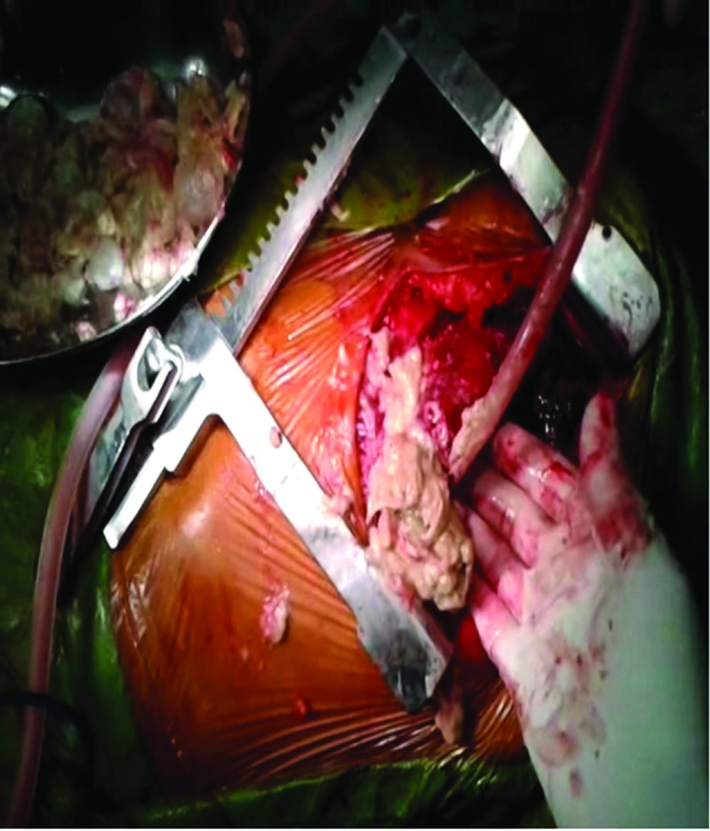 Pericardial Cyst Like Cheese Mixed With Grape Removing From Pericardium Pericardial Cyst Like Cheese Mixed With Grape Removing From Pericardium