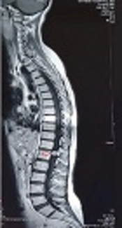 Anesthetic Management of T12 Schwannoma in a Patient with Churg-Strauss Syndrome: A Case Report