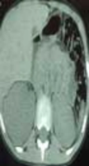 Renal Actinomycosis