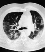 Archives of Clinical Infectious Diseases 