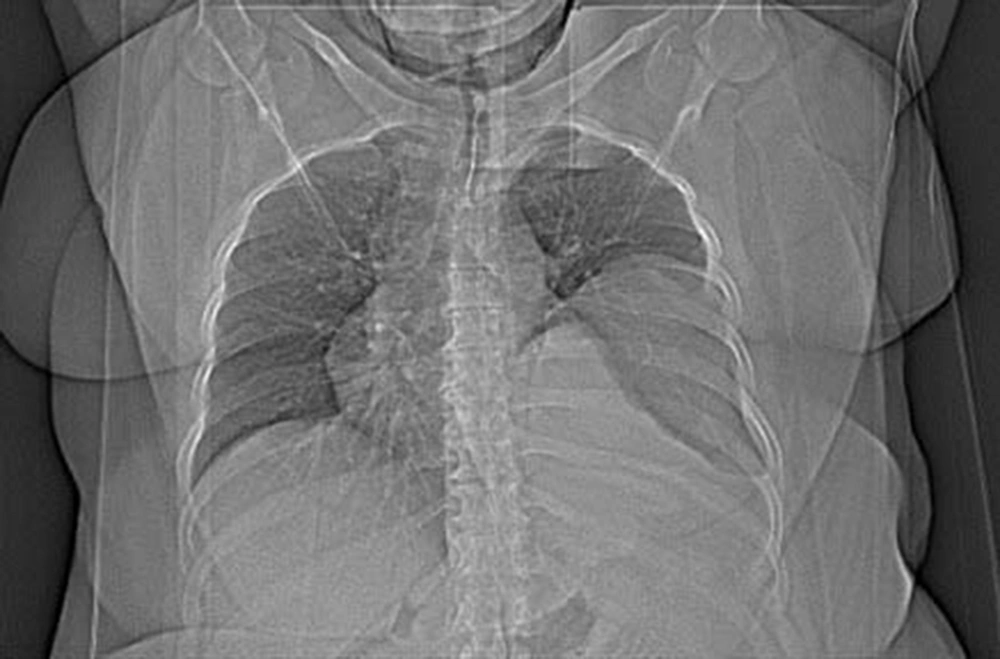 Chest CT-Scan Chest CT-Scan