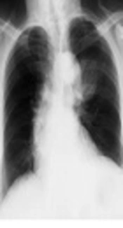 Unusual Thoracic Lipoma; A Case Report and Literature Review