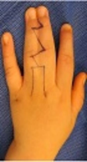 Congenital Hand Differences: A Review