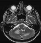 Arch Clin Infect Dis