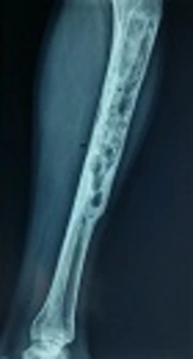 Bone Hydatid Disease with Long Term Follow-Up: A Case Report