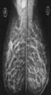 Breast Cancer