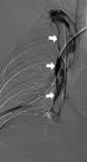 Successful Detachable Coil Embolization of Iatrogenic Superior Vena Cava Penetration by Central Venous Catheter: A Case Report