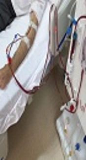 https://www.google.com/search?q=adequacy+of+dialysis&source=lnms&tbm=isch&sa=X&ved=0ahUKEwiw0KLxisLdAhVnh4sKHVSsC70Q_AUIDigB&biw=1366&bih=631#imgrc=yyPwMcjEPzzN6M: