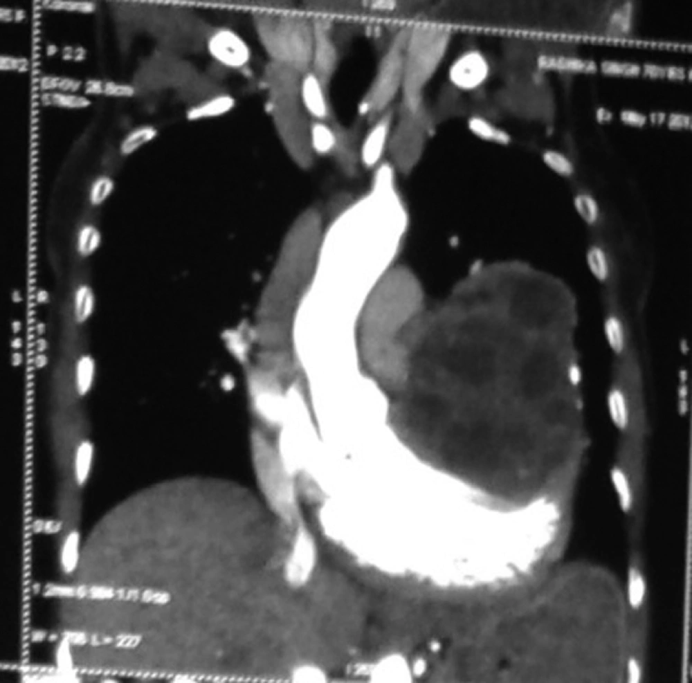 CT Scan Showing Hydatid Cyst in Pericardium CT Scan Showing Hydatid Cyst in Pericardium