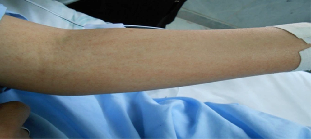 Maculopapular Lesions Maculopapular Lesions