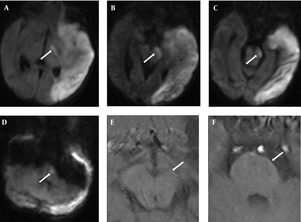DWI findings on day 5 of Life with DSCT Pre-wallerian degeneration over the PLIC (A), Peduncle (B, C), and basis pontis (D). T1WI performed when the infant was 8 months of age showed volume loss over the left cerebral peduncle (E) and basis pontis (F), compatible with Wallerian degeneration (arrow). DWI findings on day 5 of Life with DSCT Pre-wallerian degeneration over the PLIC (A), Peduncle (B, C), and basis pontis (D). T1WI performed when the infant was 8 months of age showed volume loss over the left cerebral peduncle (E) and basis pontis (F), compatible with Wallerian degeneration (arrow).