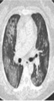 Bronchial Artery Embolization in the Management of Hemoptysis in Patients with Hematologic Diseases: Feasibility and Short-Term Efficacy