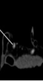 Non-Calcified Coronary Artery Plaque Characterization by Dual-Energy Computed Tomography