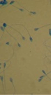 Sperm DNA Damage Before and After Kidney Transplantation