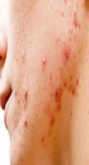 Serum Level of Insulin-Like Growth Factor 1 in Patients with Acne Vulgaris Versus Healthy Subjects