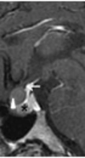 A New Perspective About Diagnosing Rathke’s Cleft Cyst: Localization of the Cyst in Reference to the Pituitary Gland