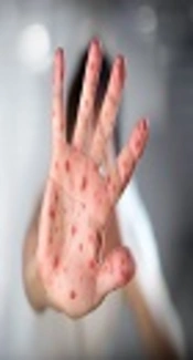 A Forty- Four Year - Old Immunized Woman with Maculopapular and Petechial Rash, Diagnosed as Measles: An Extremely Rare Presentation