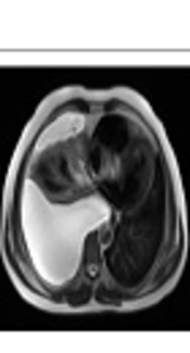 Differentiation Between Transudative and Exudative Pleural Effusions by Diffusion Weighted Magnetic Resonance Imaging