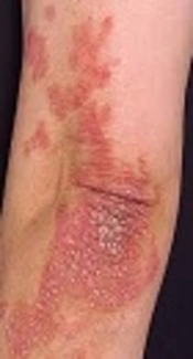 https://www.google.com/search?q=psoriasis&source=lnms&tbm=isch&sa=X&ved=0ahUKEwiQ_pCmwL_dAhUjJsAKHVvZAr8Q_AUIDigB&biw=1366&bih=631#imgrc=Md65Ps5j8520HM: