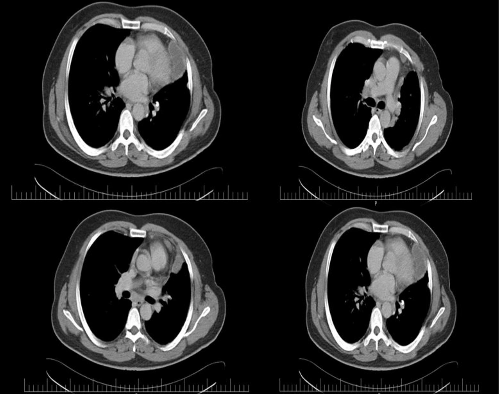 The high-resolution chest tomography (HRCT) with contrast revealed multi-localized and calcified cystic zones in the pericardium and left side of the mediastinum. The high-resolution chest tomography (HRCT) with contrast revealed multi-localized and calcified cystic zones in the pericardium and left side of the mediastinum.