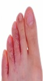 Fungal Infections Among Patients with Immunodeficiency Presenting to Medical Mycology Lab of Special Clinic of Kermanshah University of Medical Sciences (2013 - 2014)
