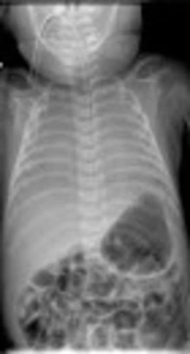 Management of Tracheal Agenesis with Esophageal Intubation Can Save Lives: A Reminder for Anaesthesiologist and Neonatologist
