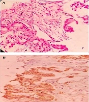 International Journal of Cancer Management