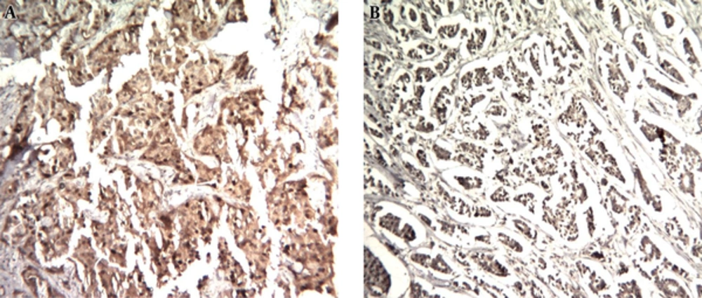 MAGE-1 Nuclear and Cytoplasmic Expression by Immunohistochemistry in Human Breast Cancer A, strong nuclear and cytoplasmic staining of most of neoplastic cells (H & E, 100 ×); B, strong nuclear and cytoplasmic staining of most of neoplastic cells (H & E, 100 ×).