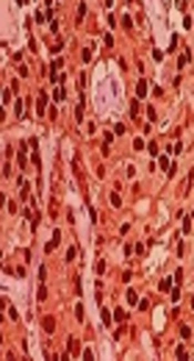 Evaluation of Additional <i>ABCC12</i> Gene Expression Character in Breast Cancer Samples Using Formal Diagnostic Profile