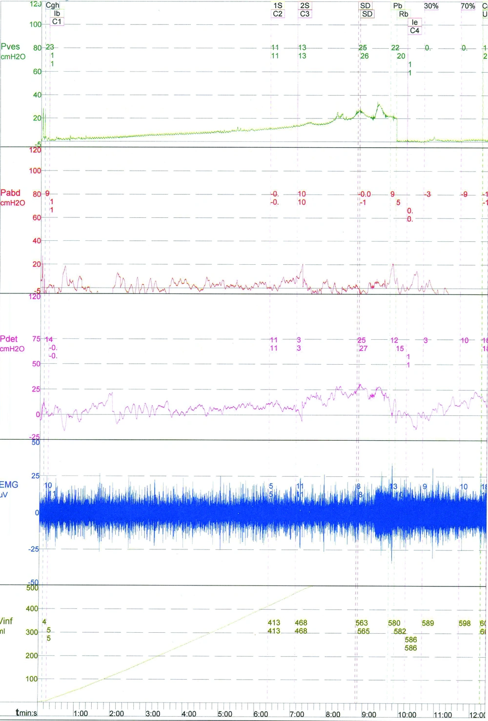 Urodynamic Study Shows Detrusor Hyposensitivity, Hypoactivity and Detrusor Sphincter Dyssynergia (DSD) Urodynamic Study Shows Detrusor Hyposensitivity, Hypoactivity and Detrusor Sphincter Dyssynergia (DSD)