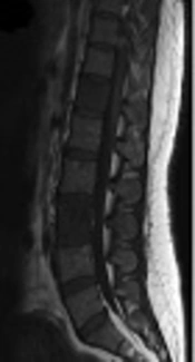 The Application of Apparent Diffusion Coefficient and Chemical Shift Images in Differentiation of Benign and Malignant Vertebral Lesions