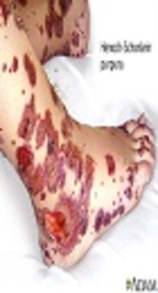 Serum and Urinary Resistin Levels in Henoch Schonlein Purpura